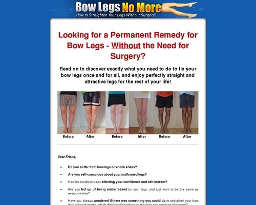 bowlegs x400 thumb Bow Legs No More - How to Straighten Your Legs Without Surgery!